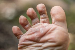 Desalix contraindicații are efecte secundare, studii clinice